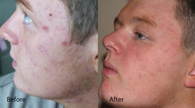 Dermalux treatment before and after 1