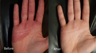 Dermalux treatment before and after 2