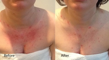 Dermalux treatment before and after 3