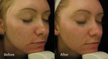 Dermalux treatment before and after 4