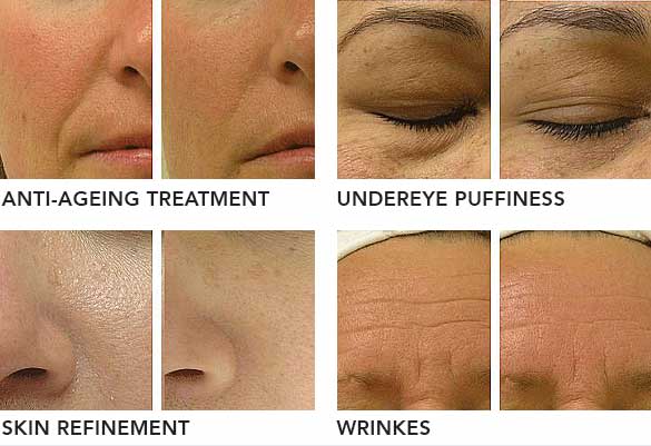 Hydradermabrasion results